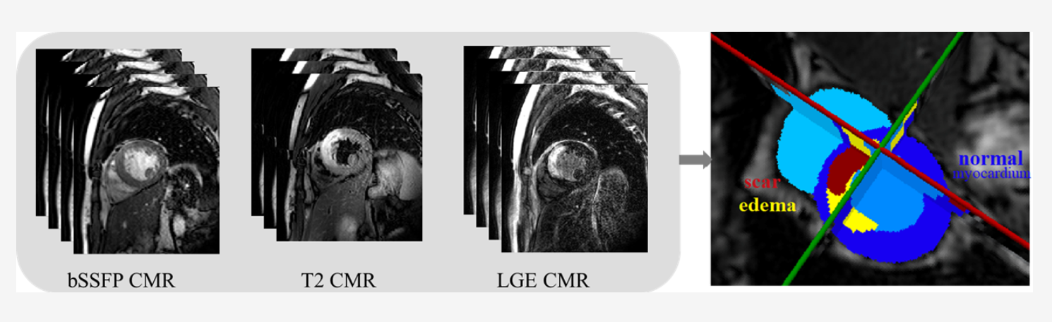 Myocardial Pathology Segmentation Combining Multi-Sequence Cardiac ...