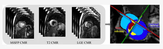 Myocardial Pathology Segmentation Combining Multi-Sequence Cardiac Magnetic Resonance Images