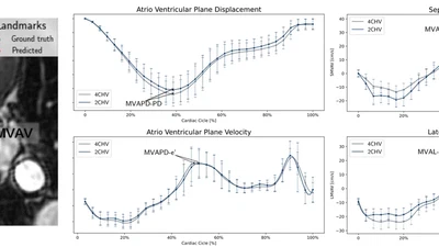 Mitral Valve Annulus Motion Parameter Extraction featured image