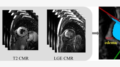 Myocardial Pathology Segmentation (Multi-Sequence CMR) featured image