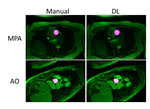 Automated Vessel Segmentation for 2D Phase Contrast MR Using Deep Learning