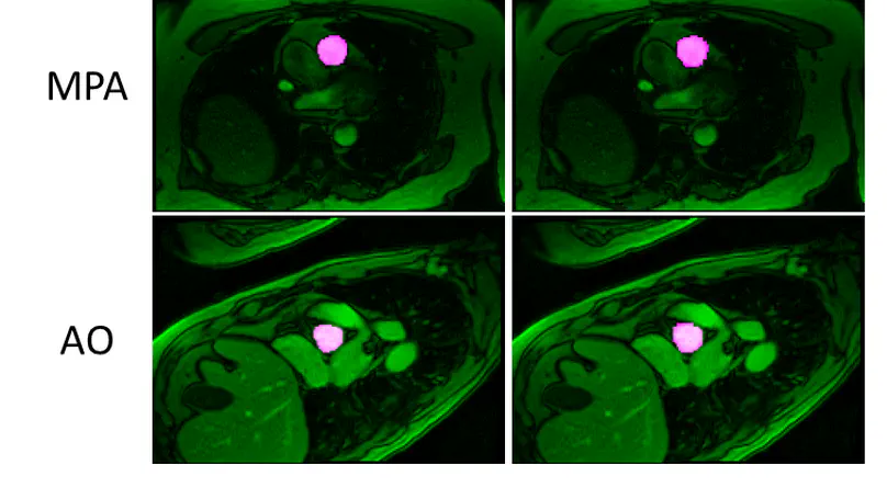 Automated Vessel Segmentation for 2D Phase Contrast MR Using Deep Learning