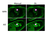 Automated Vessel Segmentation for 2D Phase Contrast MR Using Deep Learning