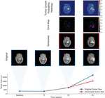 Predicting Anatomical Tumor Growth in Pediatric High-grade Gliomas via Denoising Diffusion Models